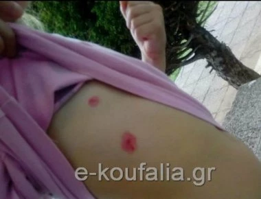 Θεσσαλονίκη: Επίθεση σκυλιών σε 7χρονη σε πάρκο